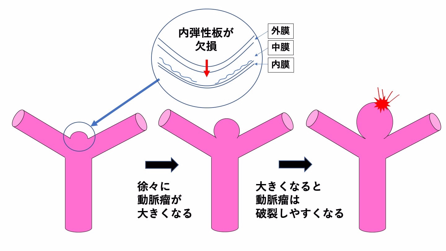 脳動脈瘤　その２　脳動脈瘤はなぜできるのか？（基礎研究編）