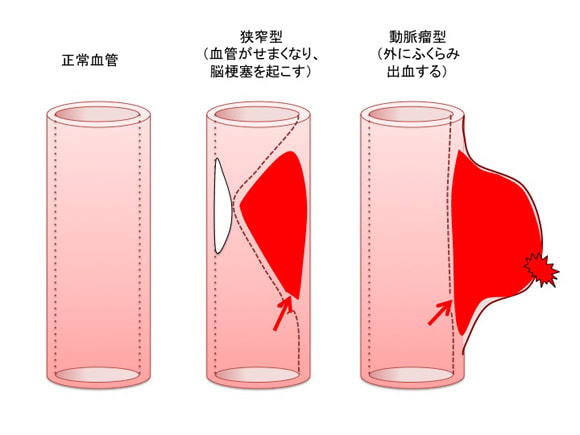 脳動脈解離