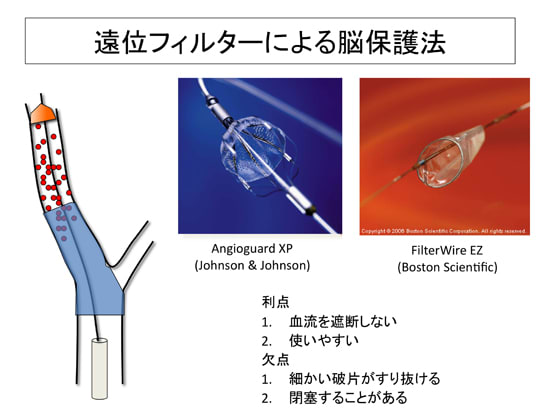 遠位フィルターによる脳保護