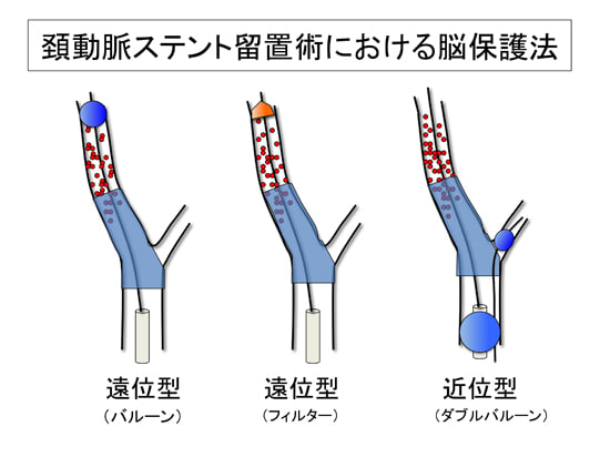 頚動脈ステント留置術における脳保護法：その種類について