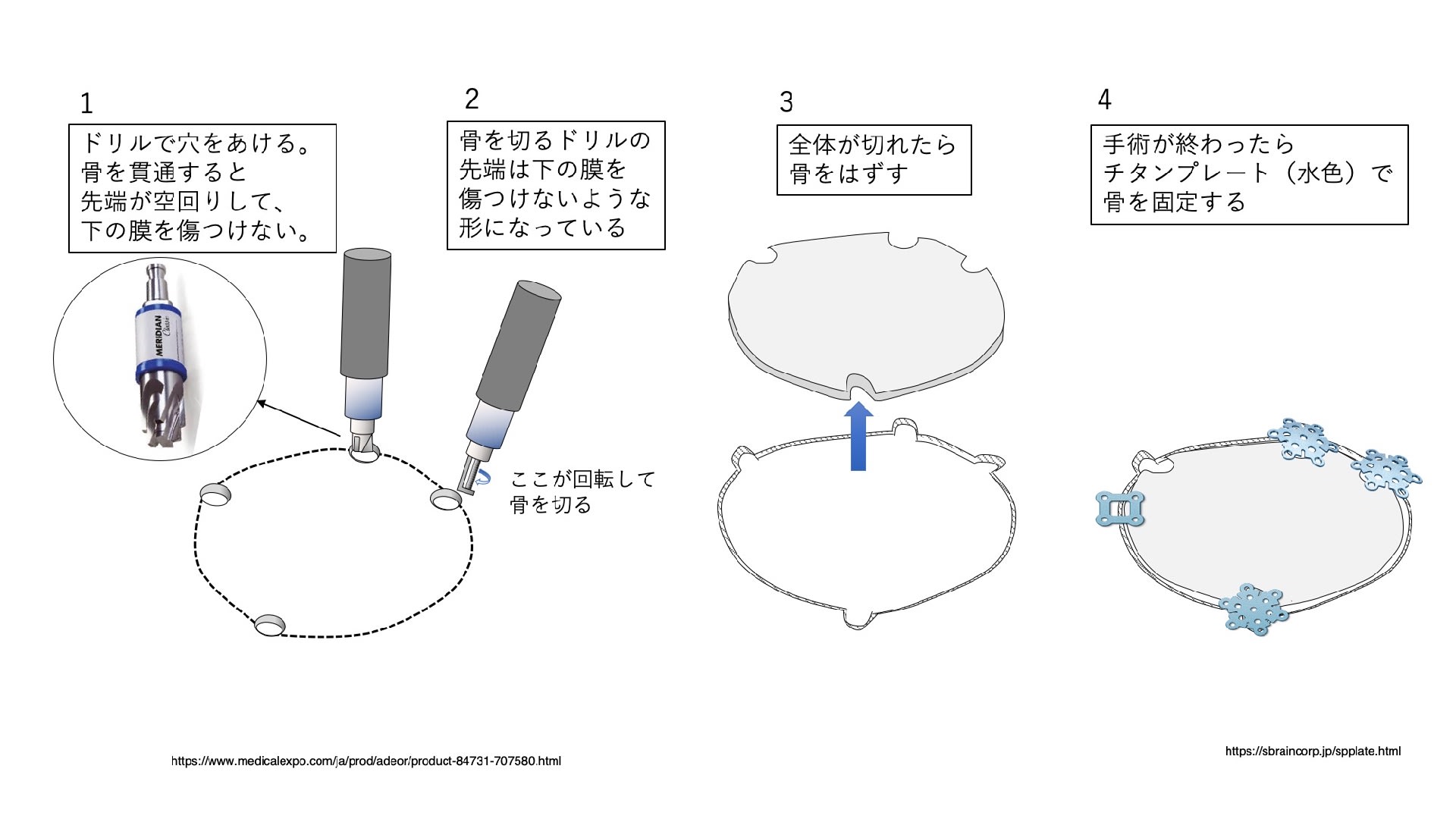 脳動脈瘤 その18 外科手術 1. クリッピング術 「骨はどうするのか？」