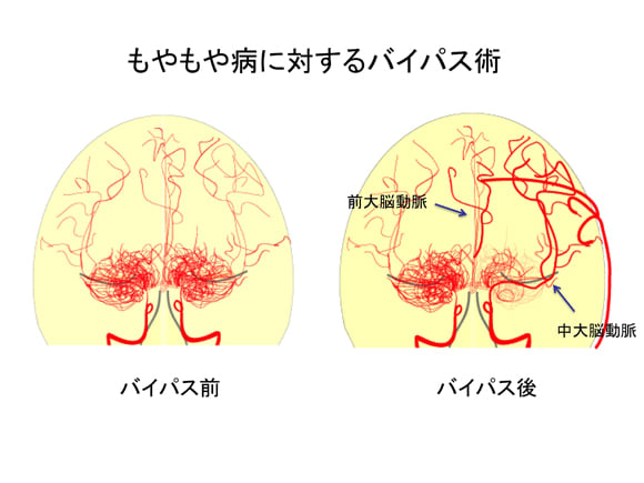 もやもや病について　その４　治療：血流を増やす　バイパス術４