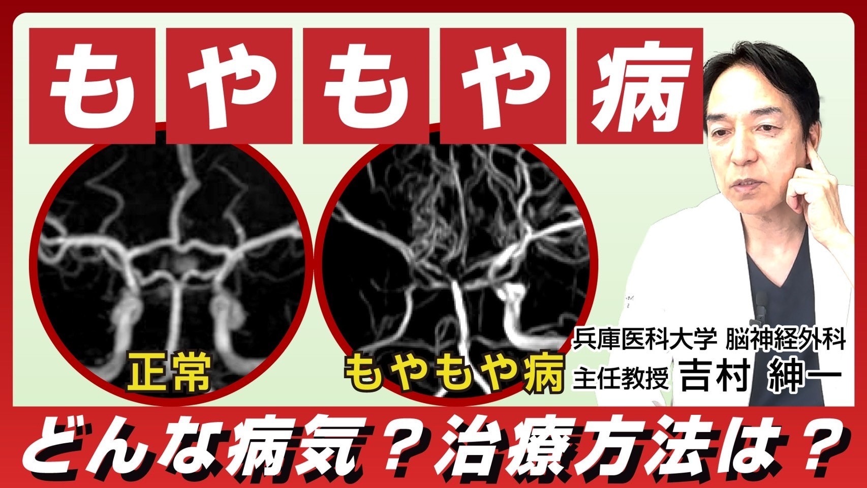 You tube 第11弾 もやもや病ってどんな病気？ 治療方法は？