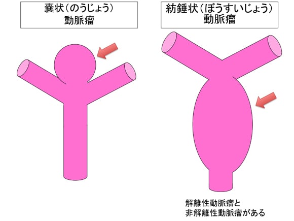 紡錘状動脈瘤について