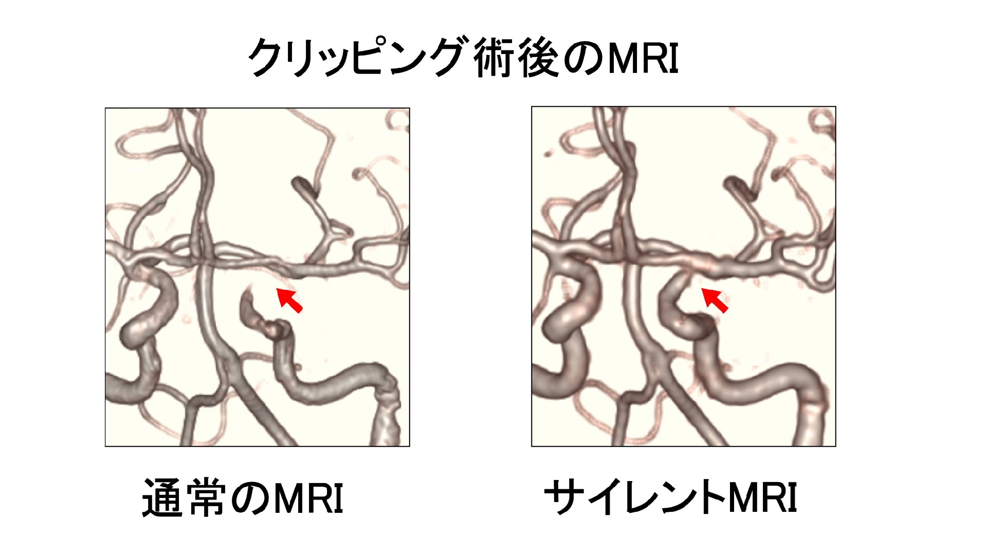 脳動脈瘤についてのQ&A その8 クリッピング術後の検査は何が良いか?