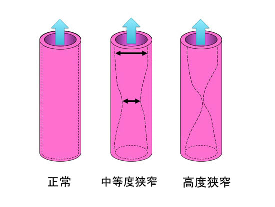 血管の狭窄2