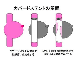 難しい動脈瘤3 カバードステント