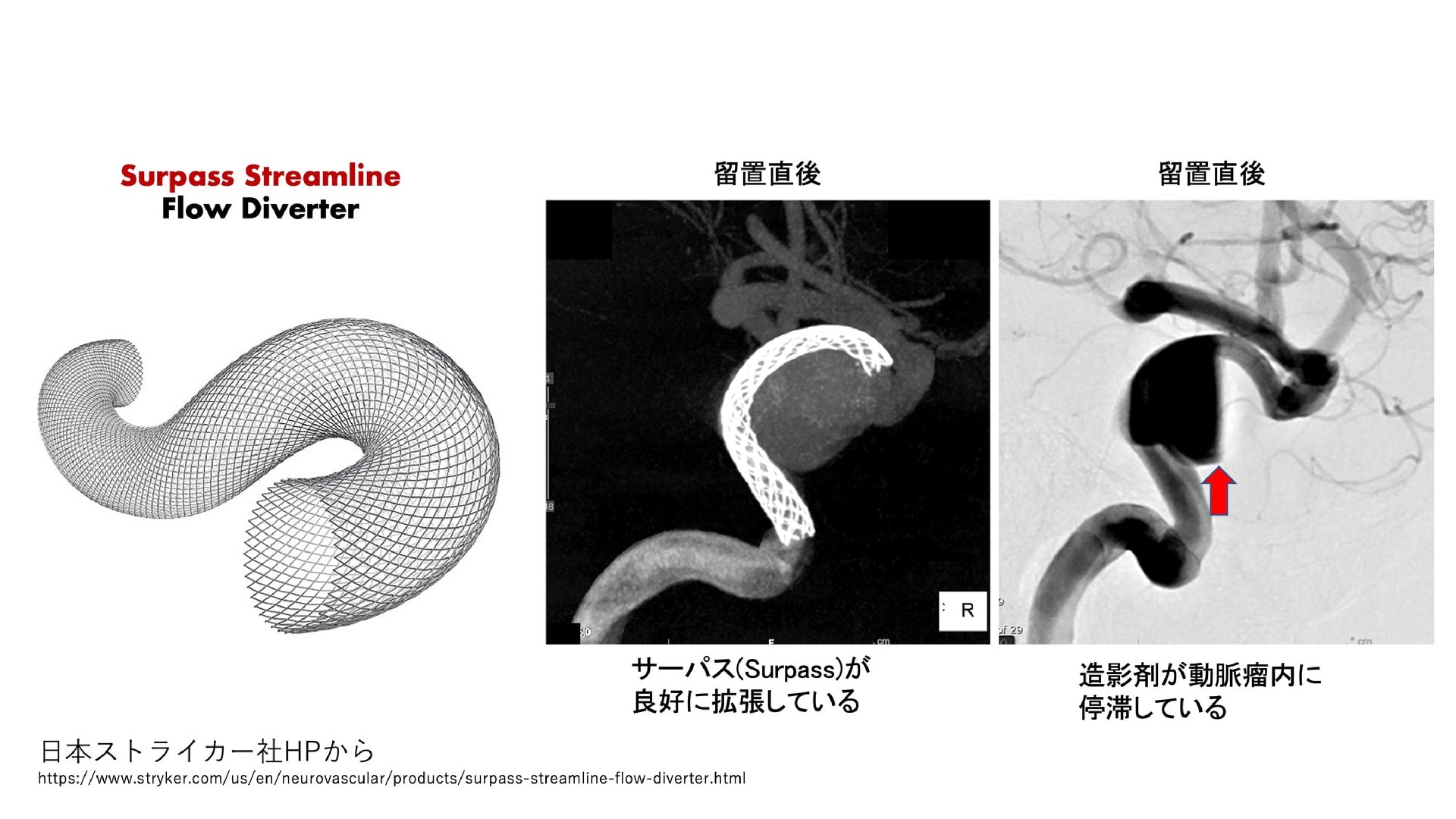 脳動脈瘤 その52 脳血管内治療:その22 もう一つのフローダイバーター Surpass
