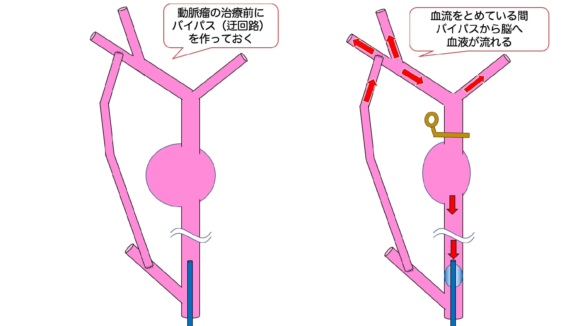 脳動脈瘤 その28 外科手術が難しい動脈瘤:大型・巨大動脈瘤 治療の工夫3