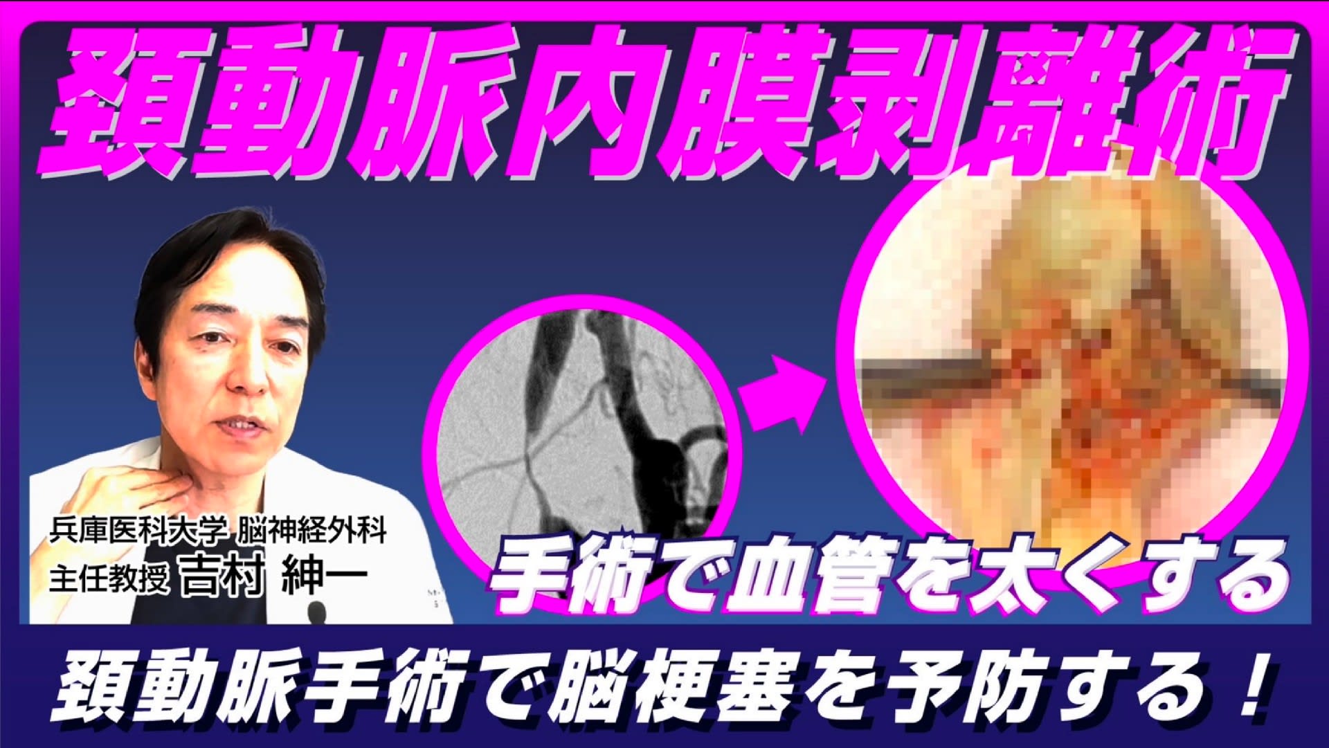 You tube 第8弾 頚動脈内膜はくり術 手術で血管を太くする!