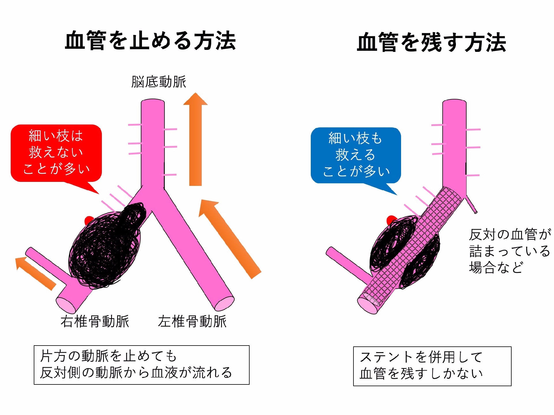 脳動脈瘤 その7 脳動脈瘤の種類(成因による分類) 解離性動脈瘤 つづき2