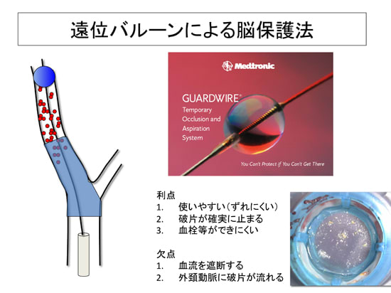 遠位バルーンによる脳保護