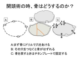 くも膜下出血ークリッピング術　その3　開頭