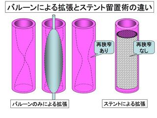 ステントとは？　その２