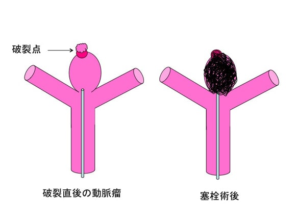 破裂脳動脈瘤のコイル塞栓術