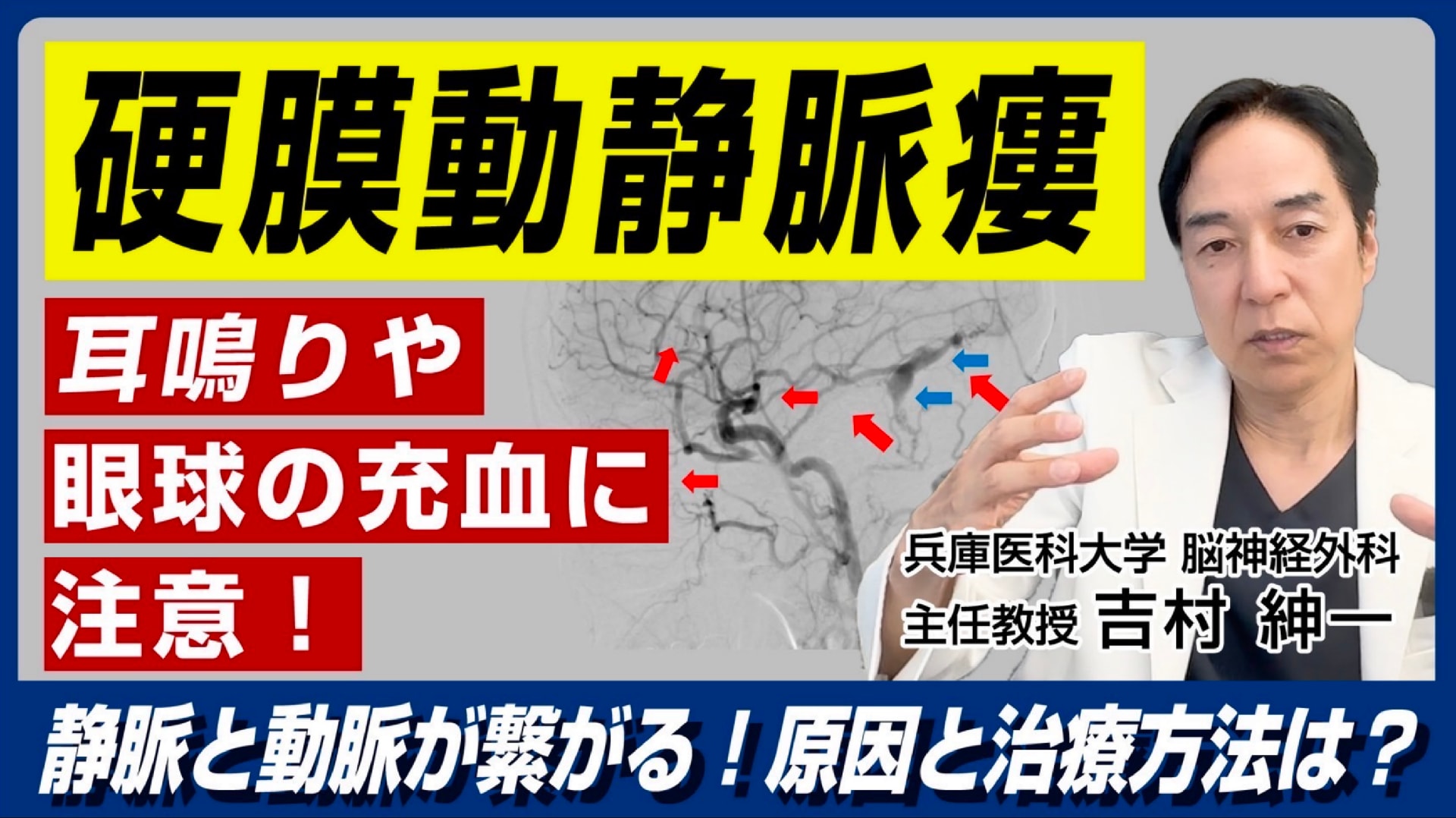 You tube 第16弾 硬膜動静脈瘻とは? 耳鳴り、目の充血に要注意