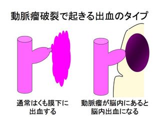 くも膜下出血ー症状　その3　（脳出血型）