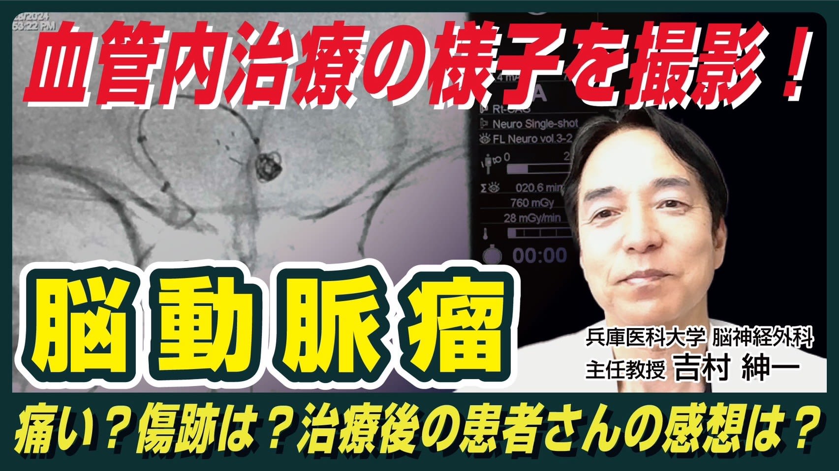You tube 第14弾 脳血管内治療:ステント併用コイル塞栓術の実際