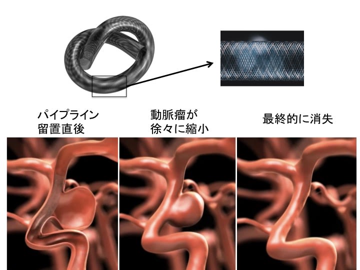 大型動脈瘤治療の最終兵器：パイプライン