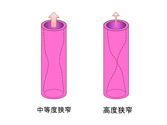 血管の狭窄3