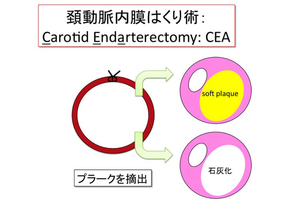 頚動脈内膜はくり術：CEA
