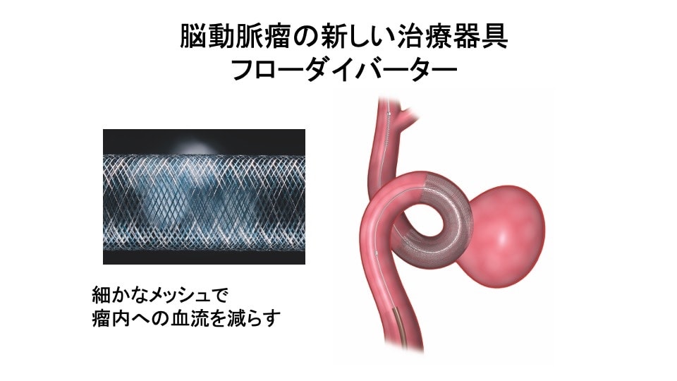 脳動脈瘤 その43 脳血管内治療:その13 フローダイバーターとは?