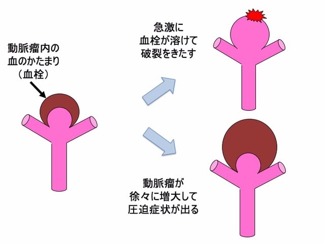 脳動脈瘤 その7 脳動脈瘤の種類（成因による分類）　血栓化動脈瘤
