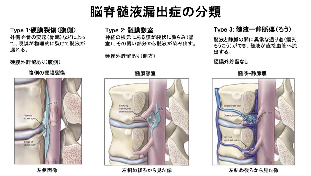 【第1回】「横になると楽になる頭痛」の正体とは?脳脊髄液漏出症の基本と3つのタイプ