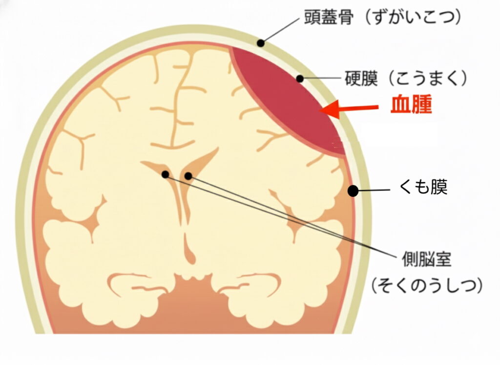 脳卒中と間違われやすい病気：慢性硬膜下血腫